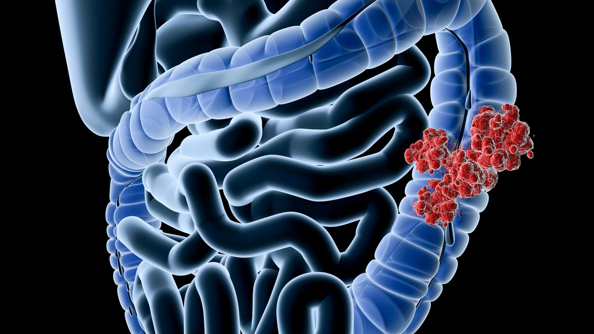 Digitale Grafik eines von Krebs befallenen Darmabschnitts. Wenn der Tumor die Darmwand bereits durchbrochen hat, verschlechtern sich die Prognosen.