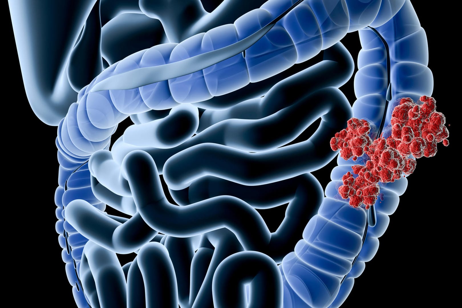 Digitale Grafik eines von Krebs befallenen Darmabschnitts. Wenn der Tumor die Darmwand bereits durchbrochen hat, verschlechtern sich die Prognosen.