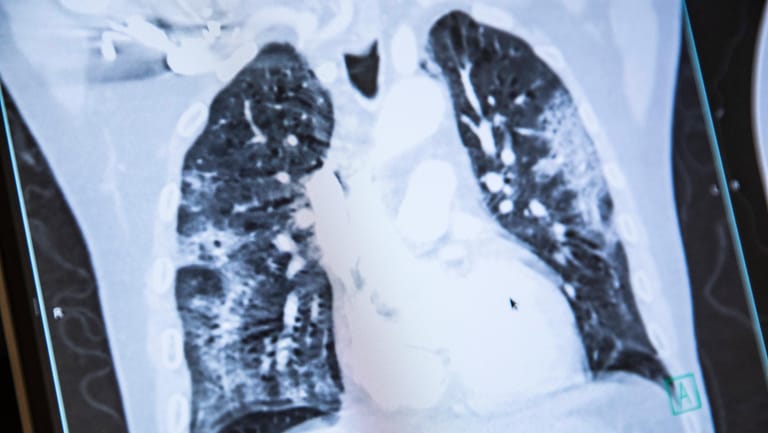 Ein Röntgenbild der Lunge nach einer Covid-19-Erkrankung: Bislang gehen Wissenschaftler nicht davon aus, dass die Mutationen zu schwereren Krankheitsverläufen als der Ursprungsvirus führen.