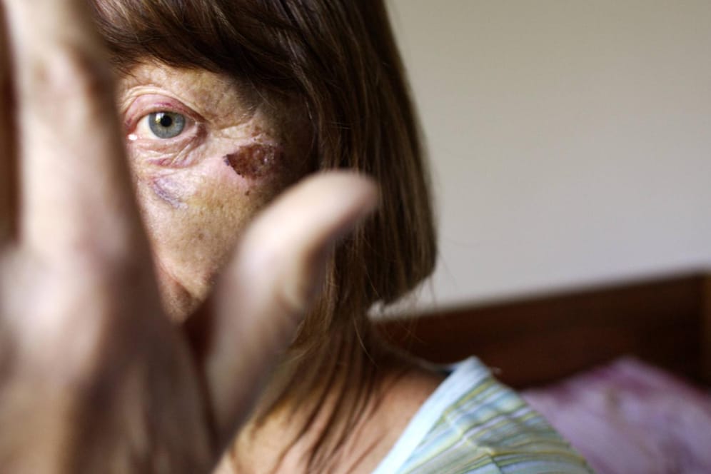 Eine Frau mit Verletzung am Auge (Symbolbild): Die große Mehrheit der Opfer von Gewalt in Partnerschaften ist weiblich.