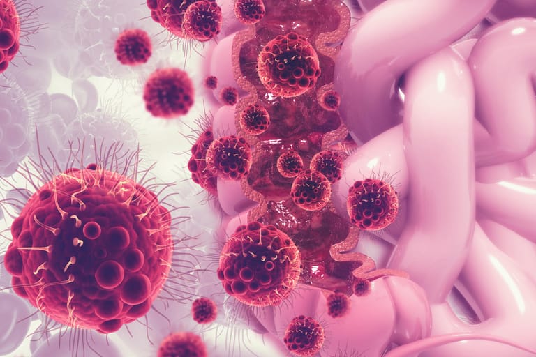 Computer-Grafik eines von Krebs befallenen Dickdarmabschnitts: Die Entwicklung eines Darmkarzinoms wird von Medizinern in vier Stadien eingeteilt.