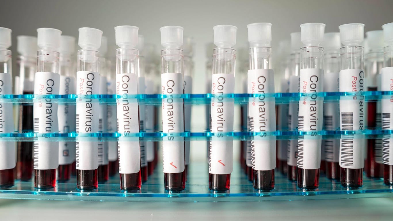 Positive Coronavirus-Tests in einem Labor: Den Probanden in Großbritannien wird die geringste mögliche Dosis an Viren zugeführt. (Symbolfoto)