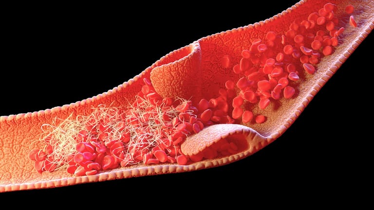 Thrombose in einer Vene: Eine Ursache für eine Venenthrombose im Gehirn kann eine genetische Veranlagung zur Blutgerinnungsstörung sein.