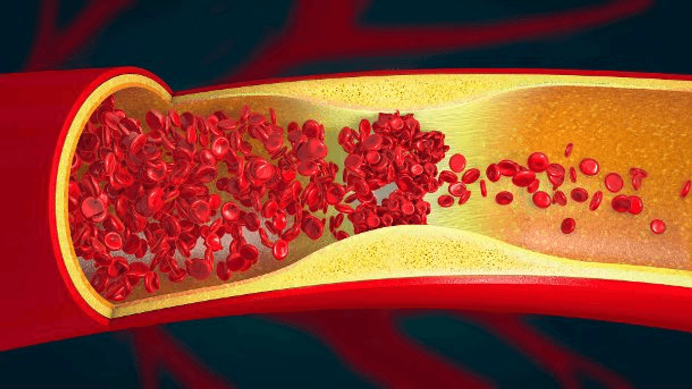 Blutgerinnsel: Bei der Hirnvenenthrombose entsteht in den Venen des Gehirns eine Abflussstörung, die gefährliche Folgen haben kann.