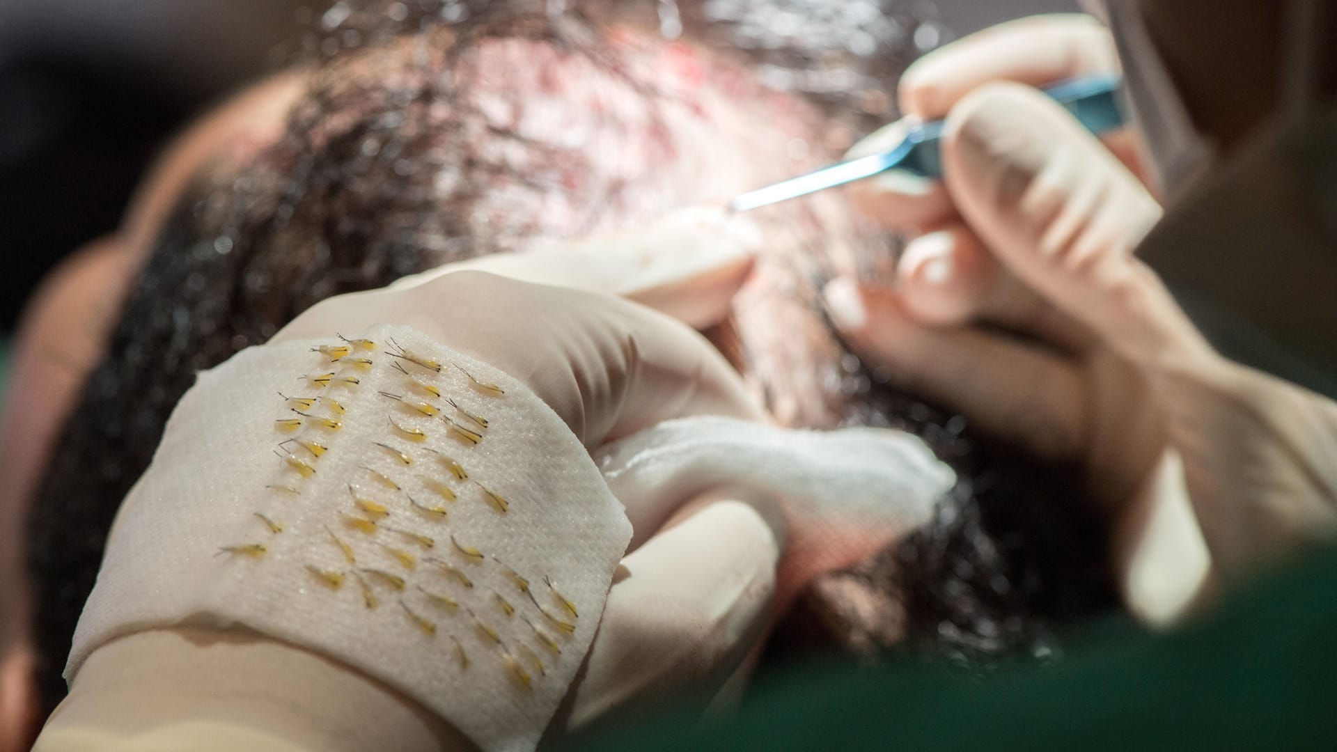 Hilfe bei Haarausfall: Durch eine Haartransplantation lassen sich kahle Stellen auf dem Kopf dauerhaft verdichten.