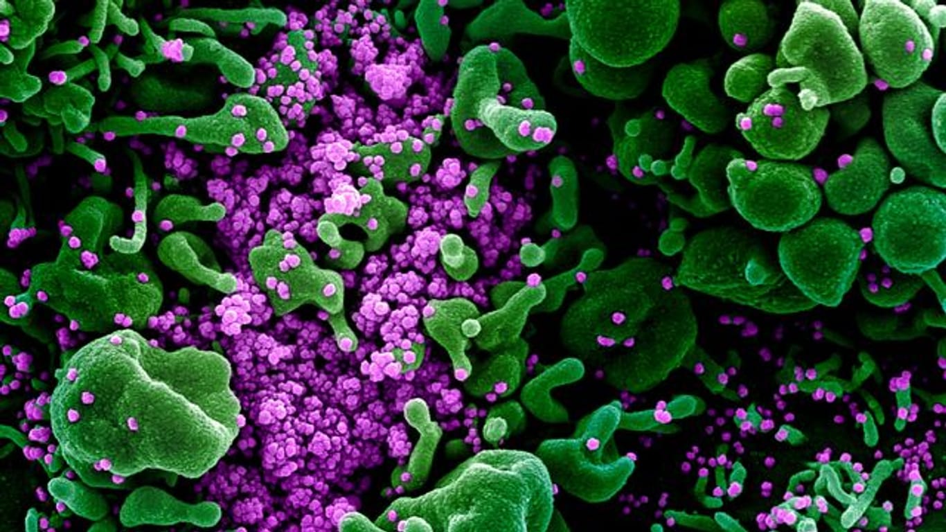 Eine Zelle (grün) ist mit dem Coronavirus (SARS-CoV-2, violett) infiziert.