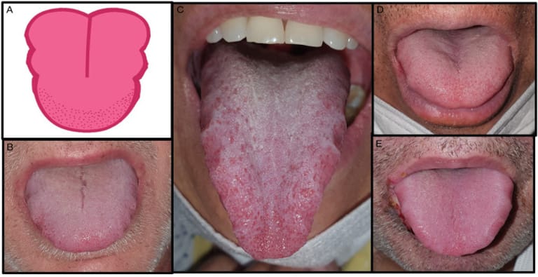 Diese Abbildungen zeigen Covid-19-Patienten mit charakteristischem Zungenödem oder vorübergehender Zungenpapillitis.
