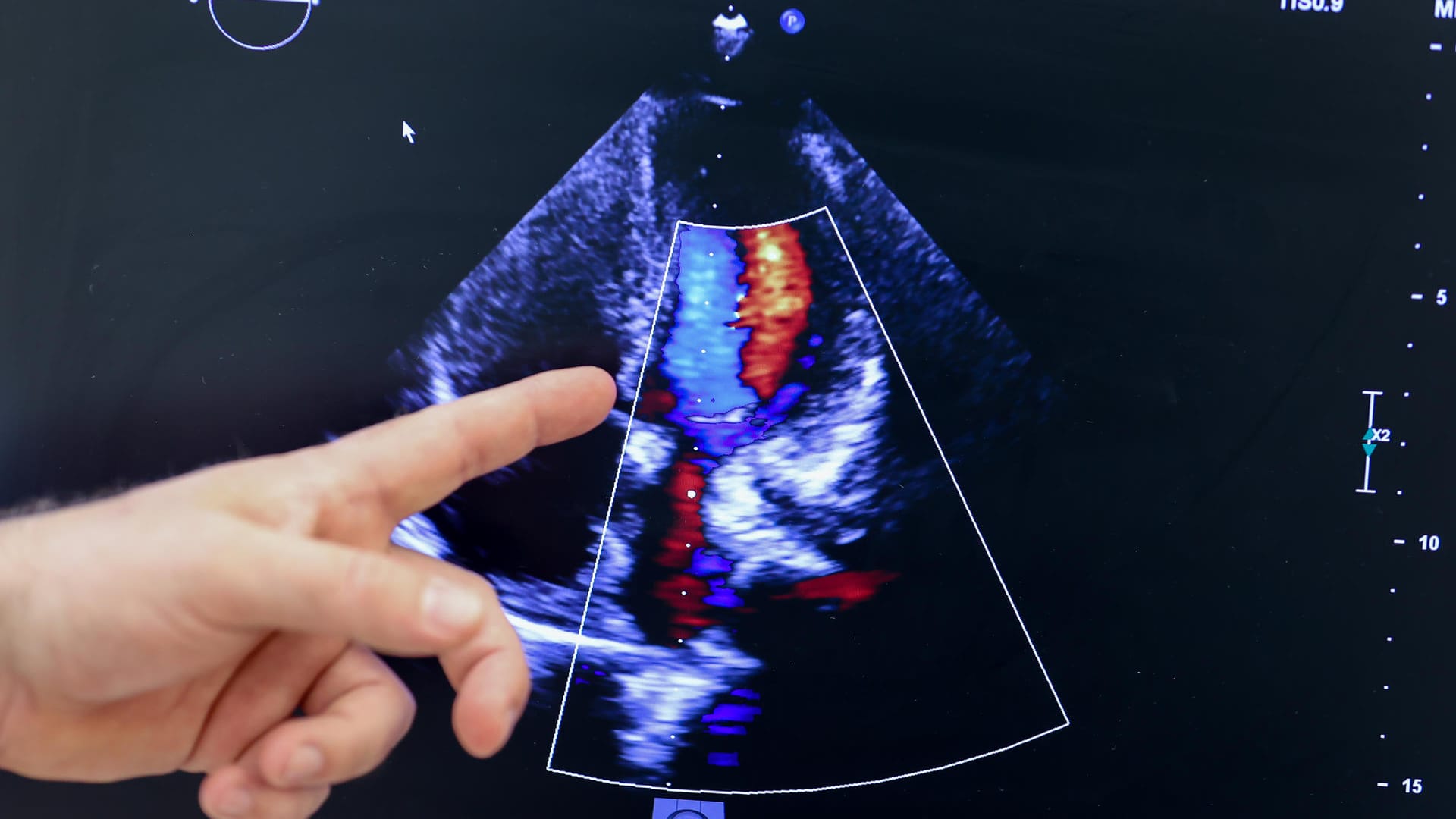 Marcel Vollroth erläutert ein Ultraschallbild des neuen Herzens eines der Zwillinge: Spenderorgane werden immer dringender gesucht.