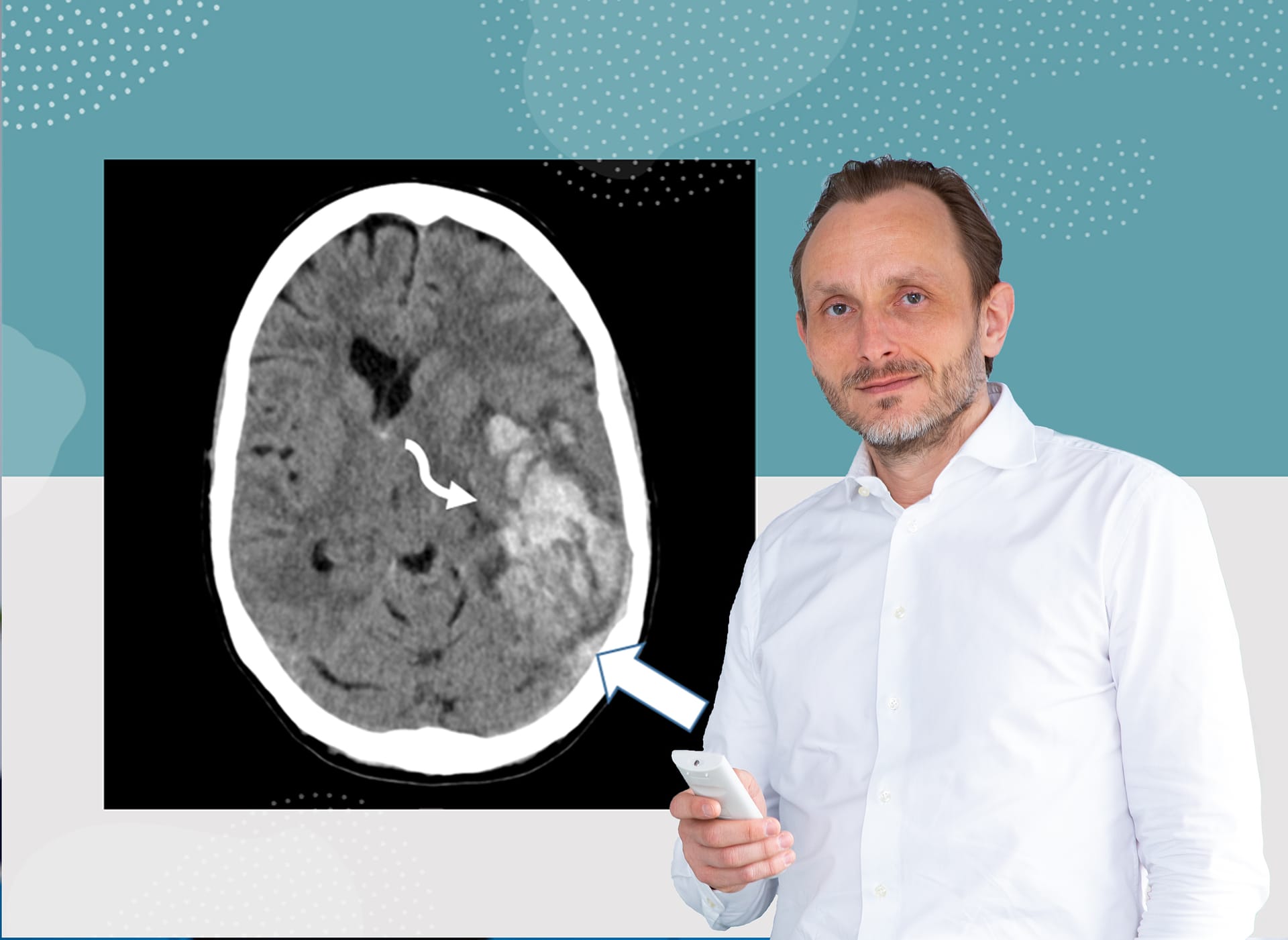 Professor Dr. Andreas Tiede mit einer computertomographischen Aufnahme: Der weiße Pfeil deutet auf eine Hirnvenenthrombose (hellgrau) hin.