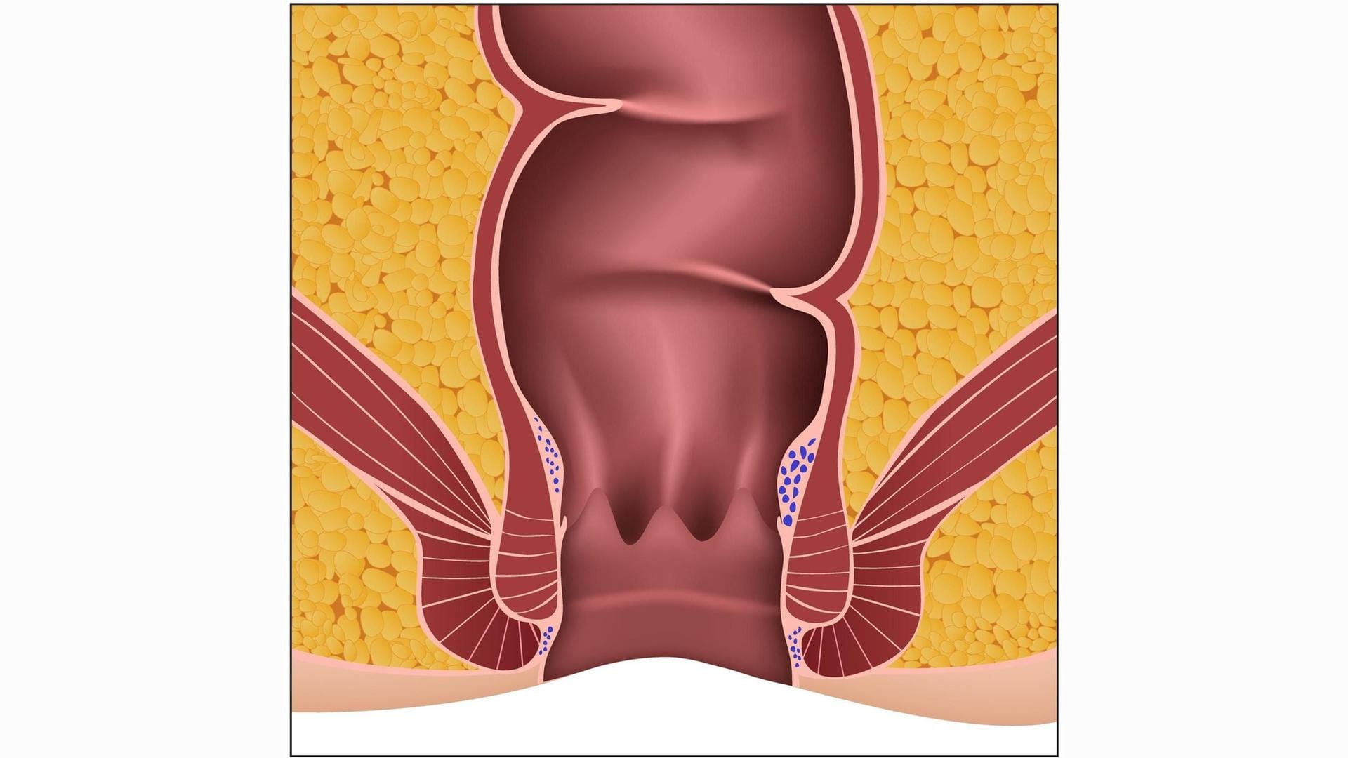 Hämorrhoiden 1. Grades: Von außen sind sie nicht sichtbar.