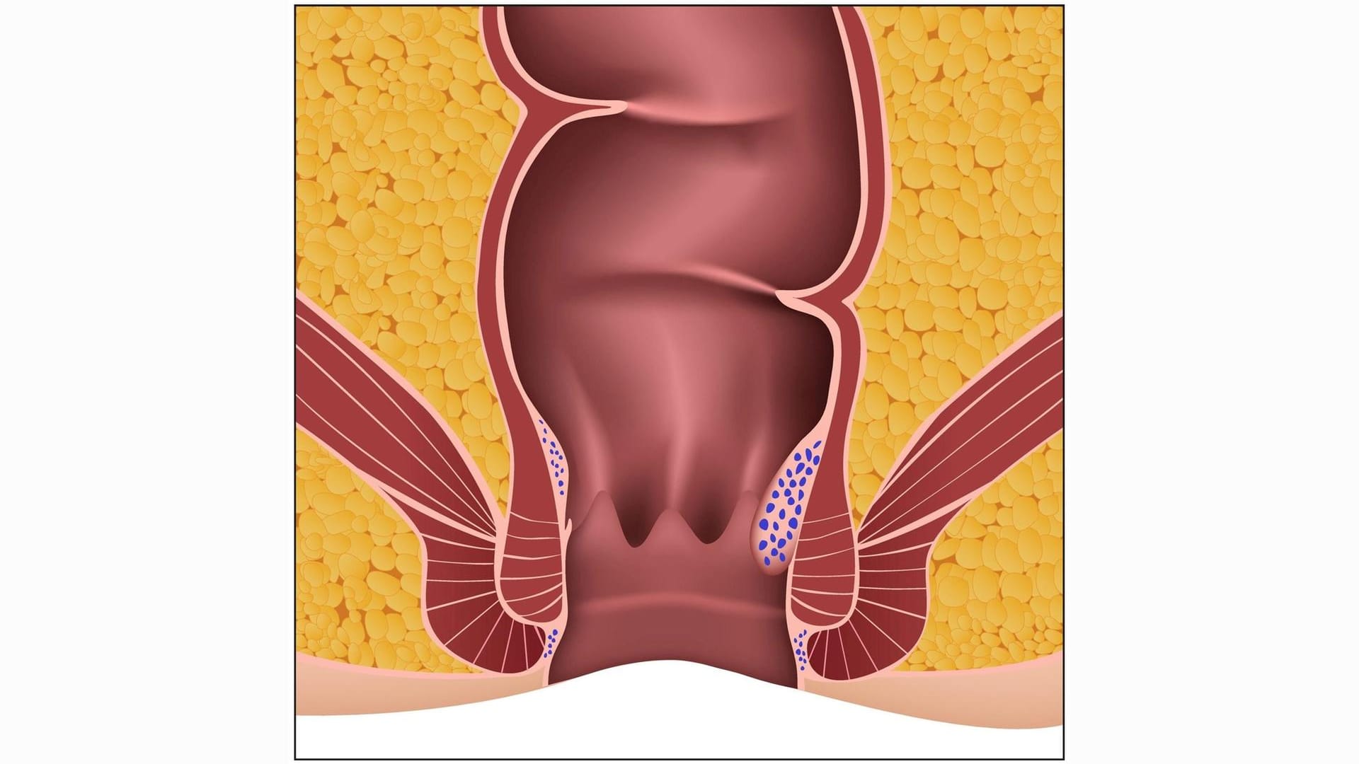 Hämorrhoiden 2. Grades: Sie treten beim Stuhlgang aus dem After hervor.