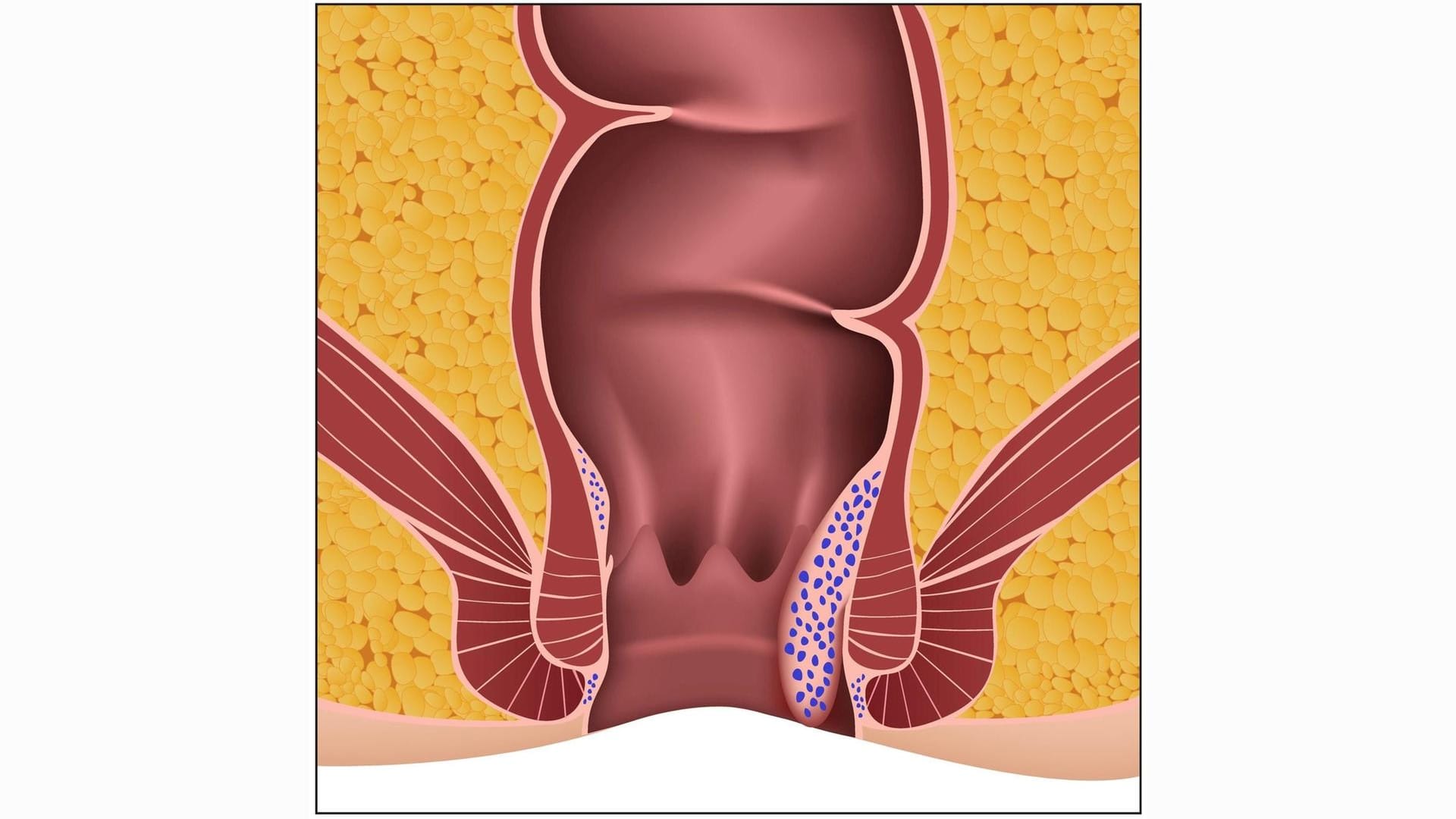 Hämorrhoiden 3. Grades: Sie können nur noch mit dem Finger wieder in den After zurückgeschoben werden.