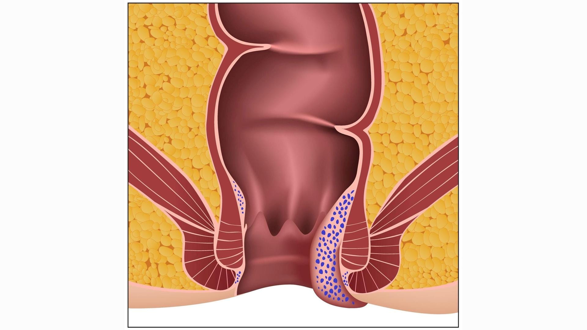 Hämorrhoiden 4. Grades: Sie ragen permanent aus dem After heraus.