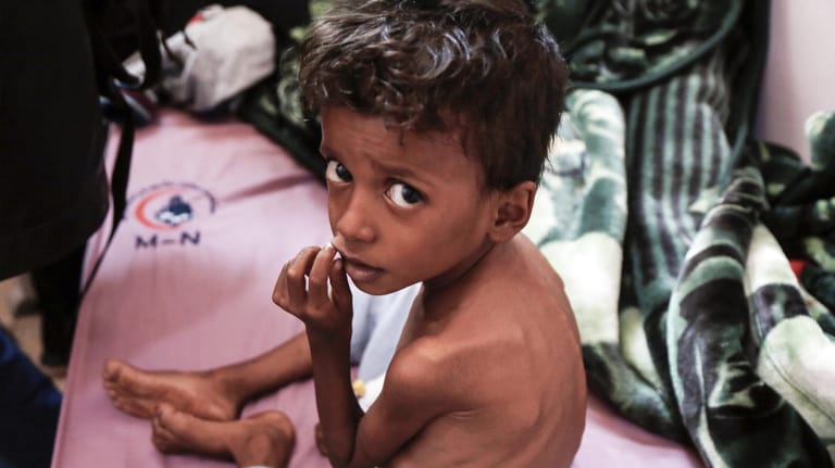 Ein unterernährtes Kind bekommt im Februar 2021 in einer Klinik im Jemen Hilfe: Millionen Kinder leiden weltweit unter den Folgen von Unterernährung.