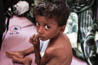Ein unterernährtes Kind bekommt im Februar 2021 in einer Klinik im Jemen Hilfe: Millionen Kinder leiden weltweit unter den Folgen von Unterernährung.