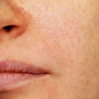 Eine junge Frau mit Problemhaut: Große Poren sind nicht nur ein optisches Problem. Sie begünstigen auch Hautunreinheiten.