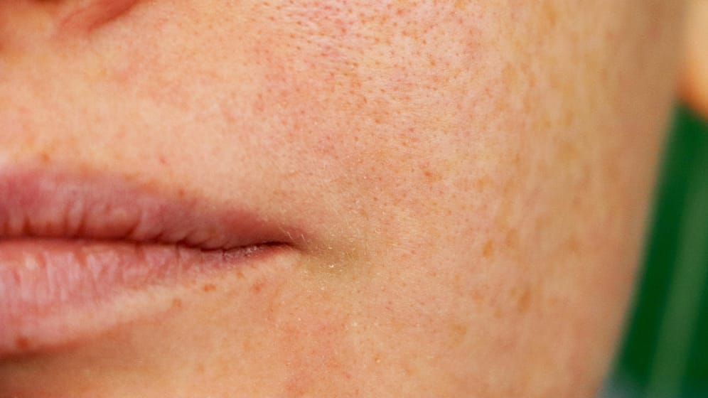 Eine junge Frau mit Problemhaut: Große Poren sind nicht nur ein optisches Problem. Sie begünstigen auch Hautunreinheiten.