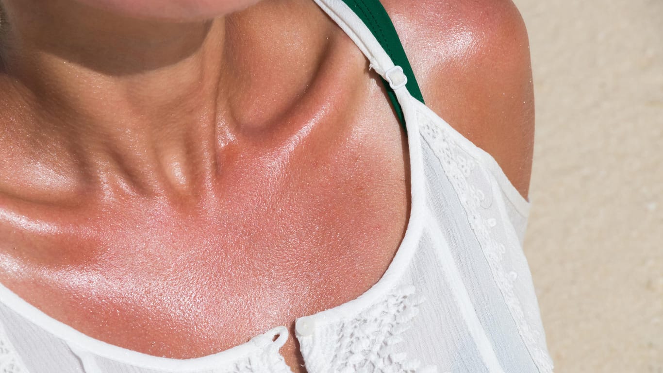 Gerötete Haut: Mehrere Hausmittel helfen gegen Sonnenbrand.