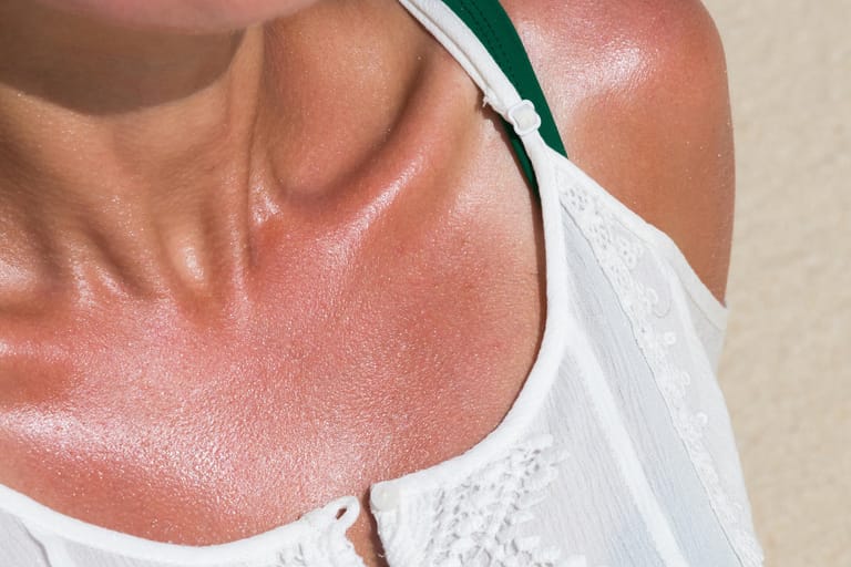 Gerötete Haut: Mehrere Hausmittel helfen gegen Sonnenbrand.