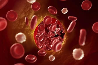 Als Thrombose bezeichnet man die Verschleppung eines Blutgerinnsels in die Blutbahn. Dies kann zu einem lebensgefährlichen Gefäßverschluss führen.