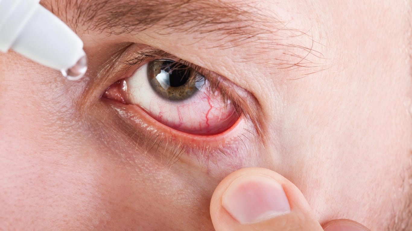 Bei einer Bindehautenzündung können Augentropfen helfen.