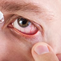 Bei einer Bindehautenzündung können Augentropfen helfen.