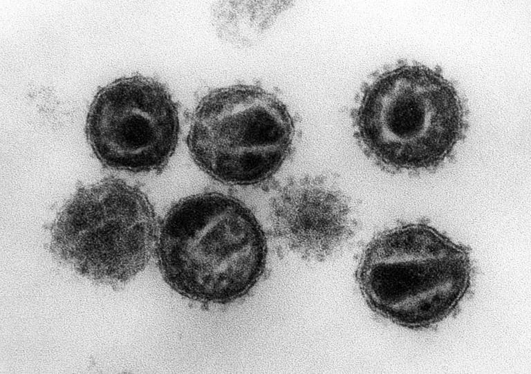 HI-Virus: Eine unbehandelte HIV-Infektion führt nach einer unterschiedlich langen, meist mehrjährigen symptomfreien Latenzphase in der Regel zu AIDS. Als Todesursache nimmt die Erkrankung Platz vier der häufigsten erkrankungsbedingten Todesursachen ein. Seit 1996 kann AIDS mit der Kombinationstherapie behandelt werden.