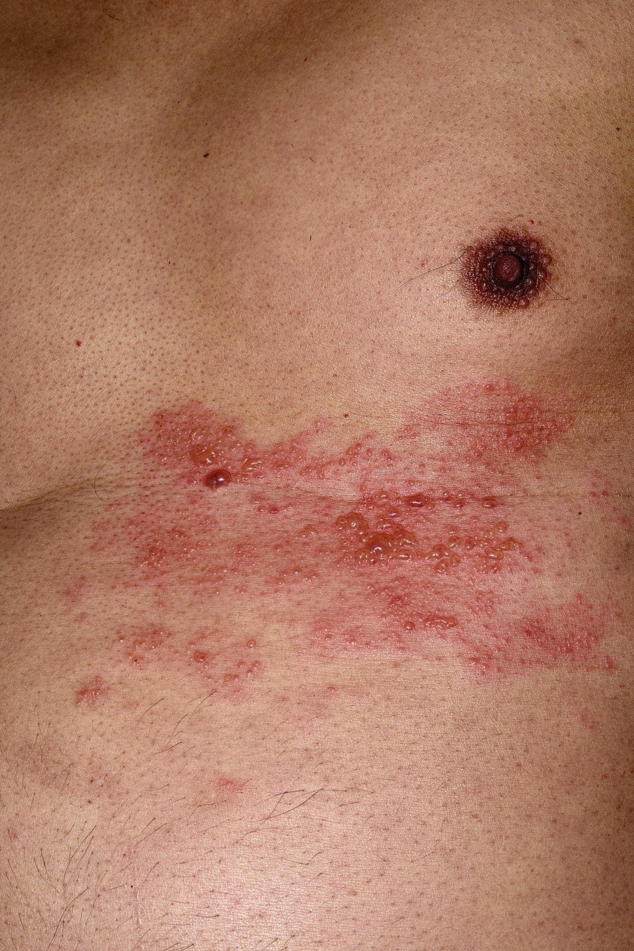 Die roten Bläschen bilden sich häufig auf Brust oder Rücken.