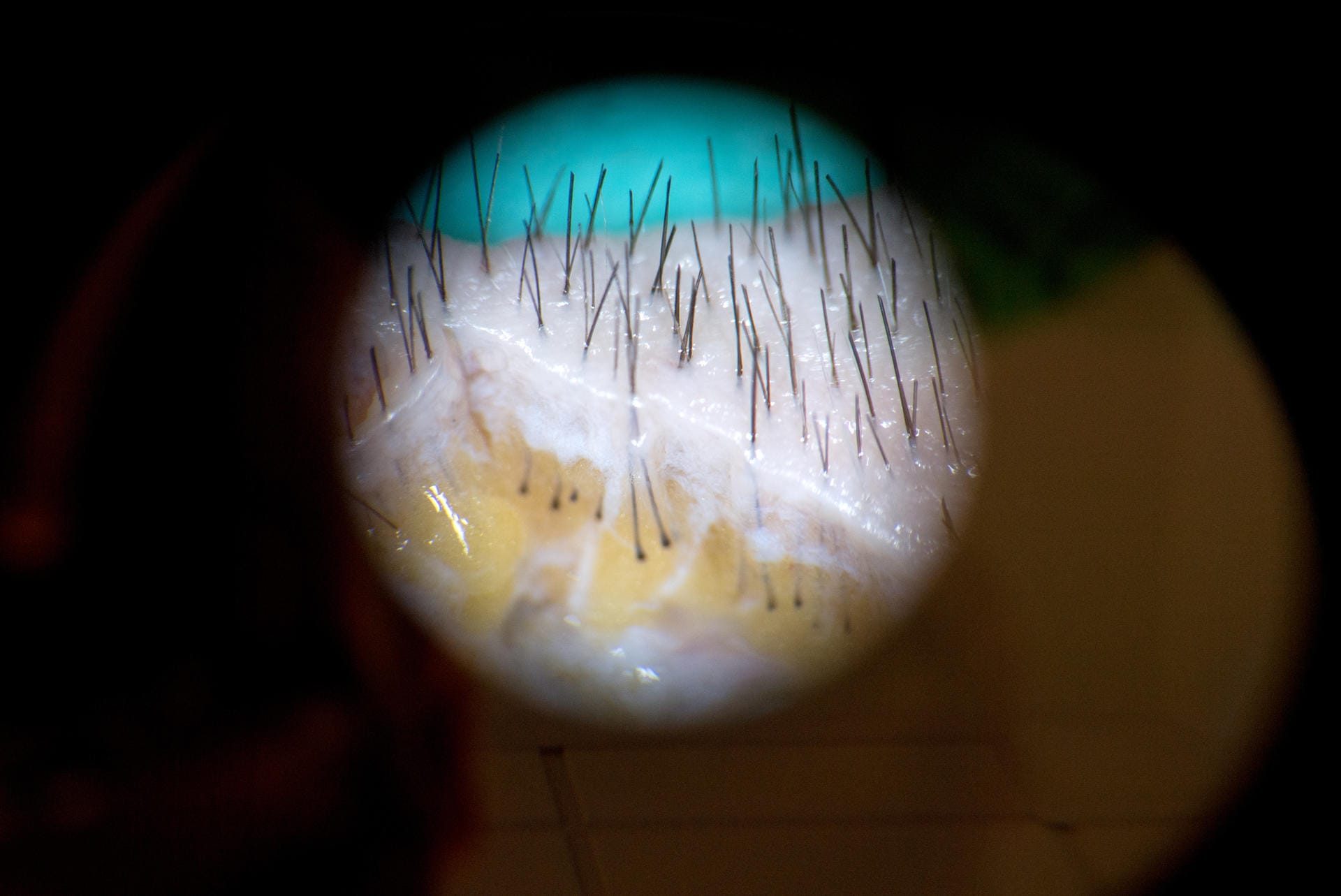 Haarstreifen unter dem Mikroskop: Daraus werden Haarwurzeln für die Transplantation extrahiert.