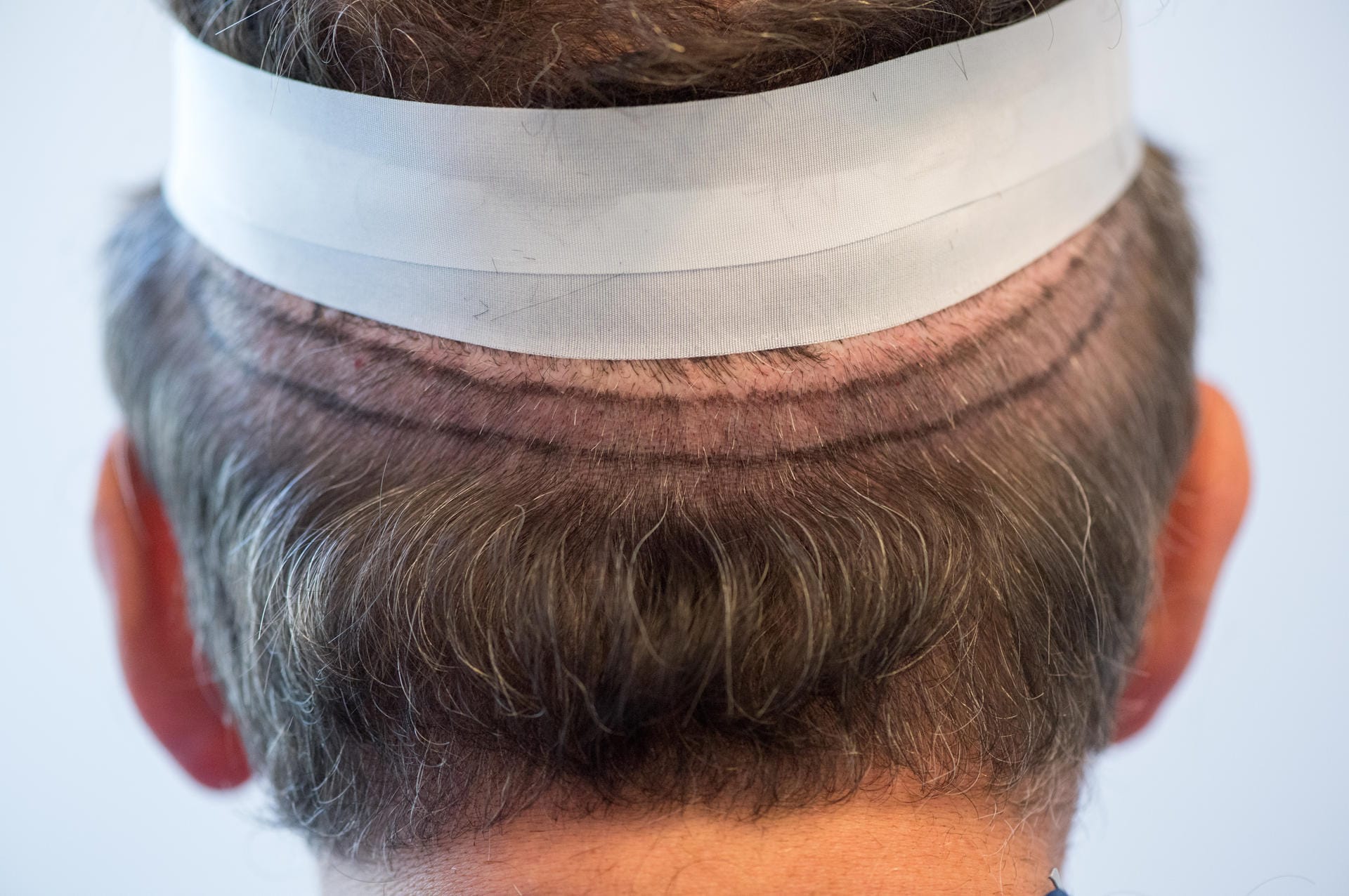 Bei der Streifenentnahme wird da, wo noch genügend Haare wachsen, ein schmaler Haarstreifen entnommen um daraus die Haarwurzeln zu entnehmen.