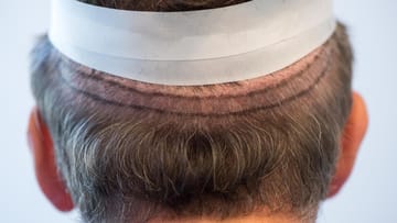 Bei der Streifenentnahme wird da, wo noch genügend Haare wachsen, ein schmaler Haarstreifen entnommen um daraus die Haarwurzeln zu entnehmen.