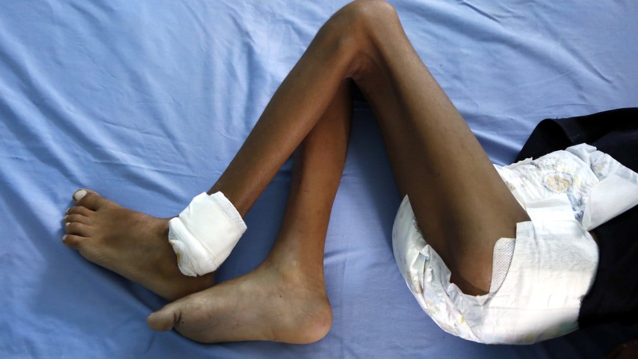 Ein unterernährtes Kind liegt in einem Krankenhaus in Hudaida. Ein unterernährtes Kind liegt in einem Krankenhaus in Hudaida.