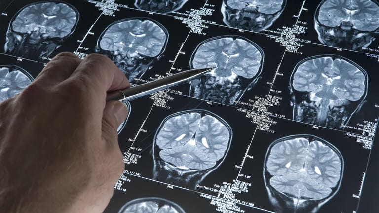 Ein Scan vom Gehirn zeigt, ob eine Alzheimer-Demenz vorliegt.