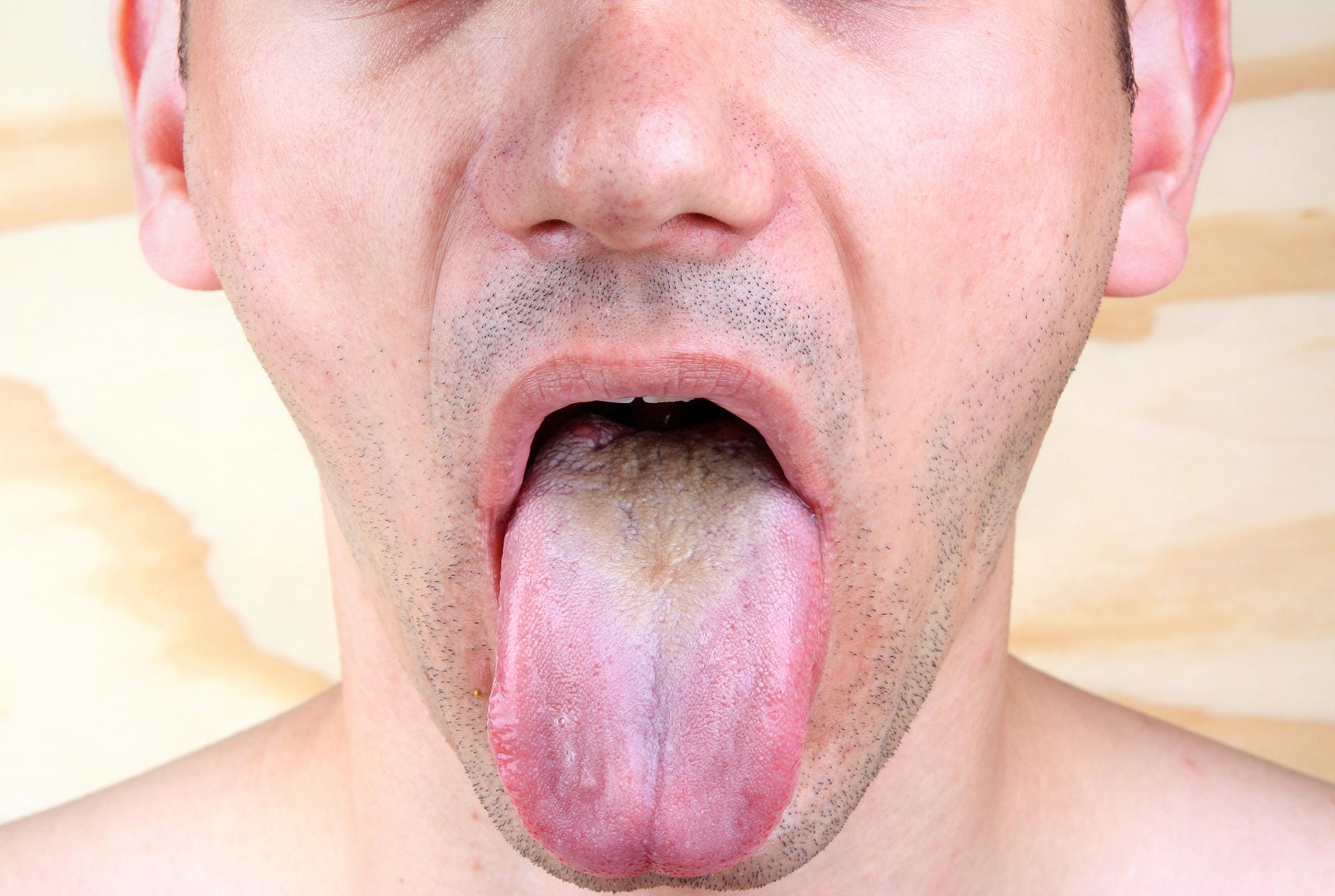 Zungenpilz: Die Erkrankung wird durch eine Infektion mit dem Hefepilz Candida albicans ausgelöst.