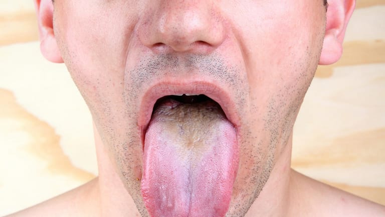 Zungenpilz: Die Erkrankung wird durch eine Infektion mit dem Hefepilz Candida albicans ausgelöst.