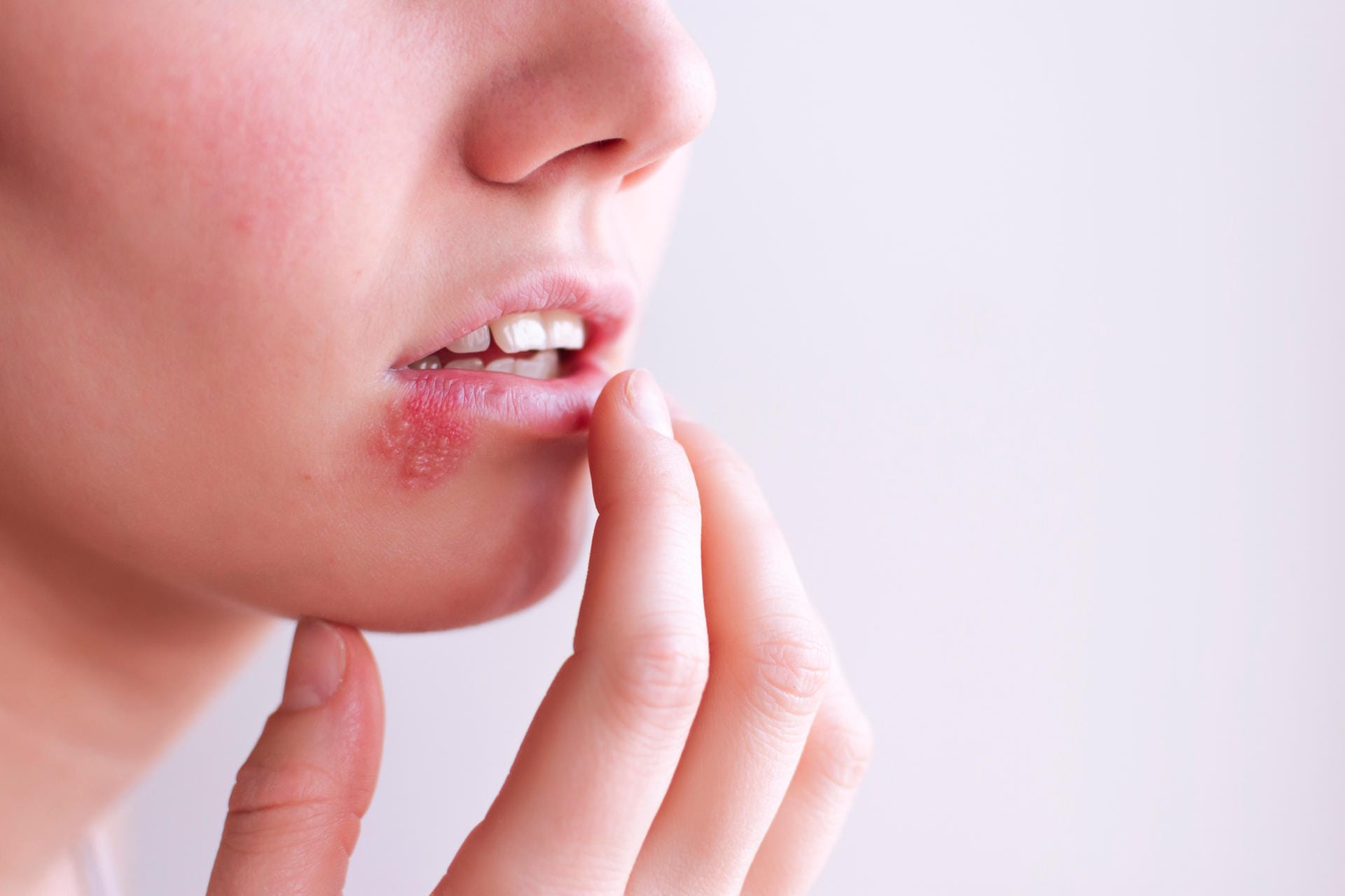 Mundfäule: Die Krankheit wird durch Herpes ausgelöst und ist stark ansteckend.