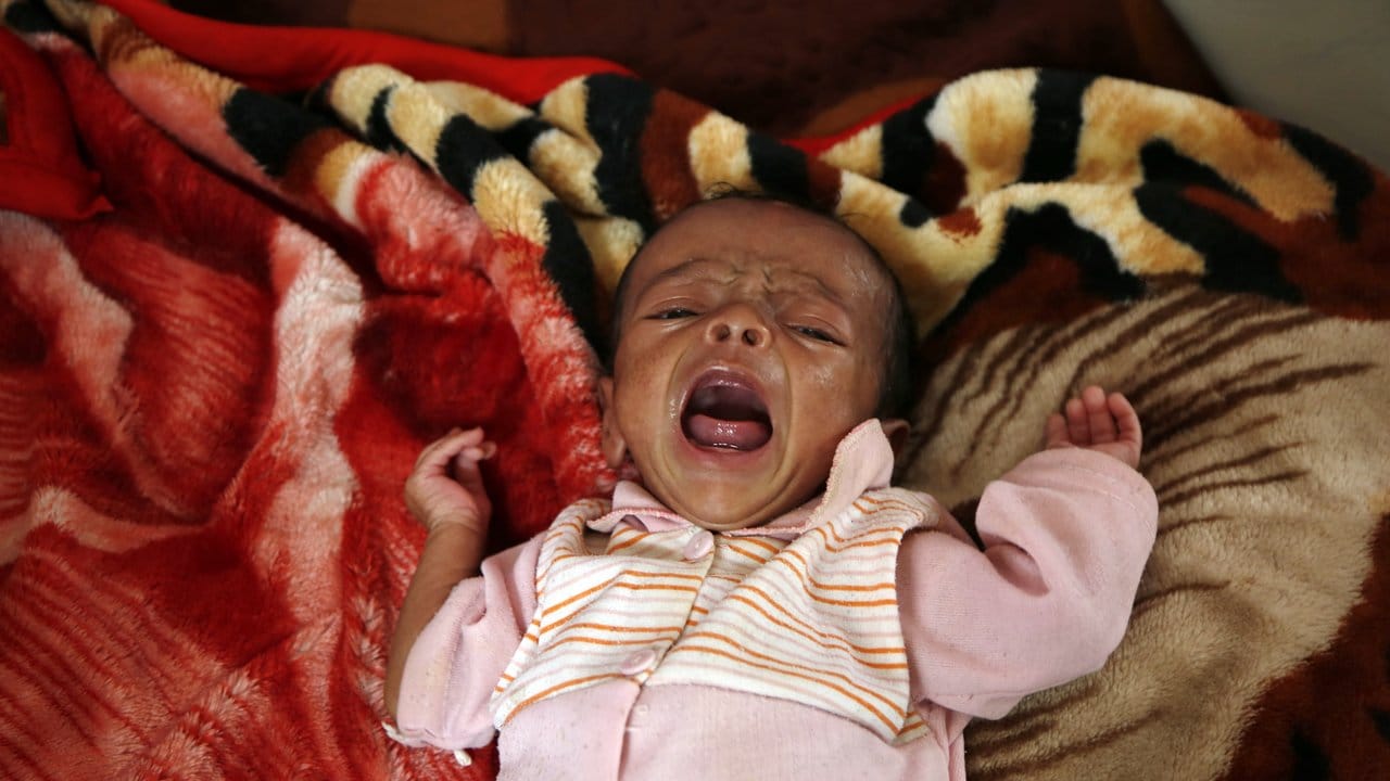 Das richtet der Krieg im Jemen an: Ein unterernährtes Kind schreit in einem Auffangzentrum in Sanaa.