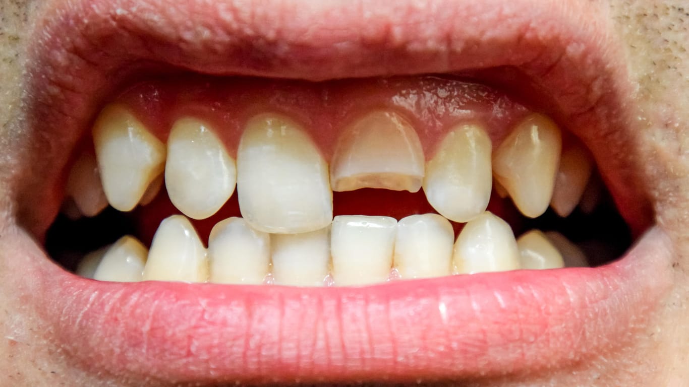 Mann mit abgebrochenem Schneidezahn: Wer nachts knirscht, macht seine Zähne kaputt.