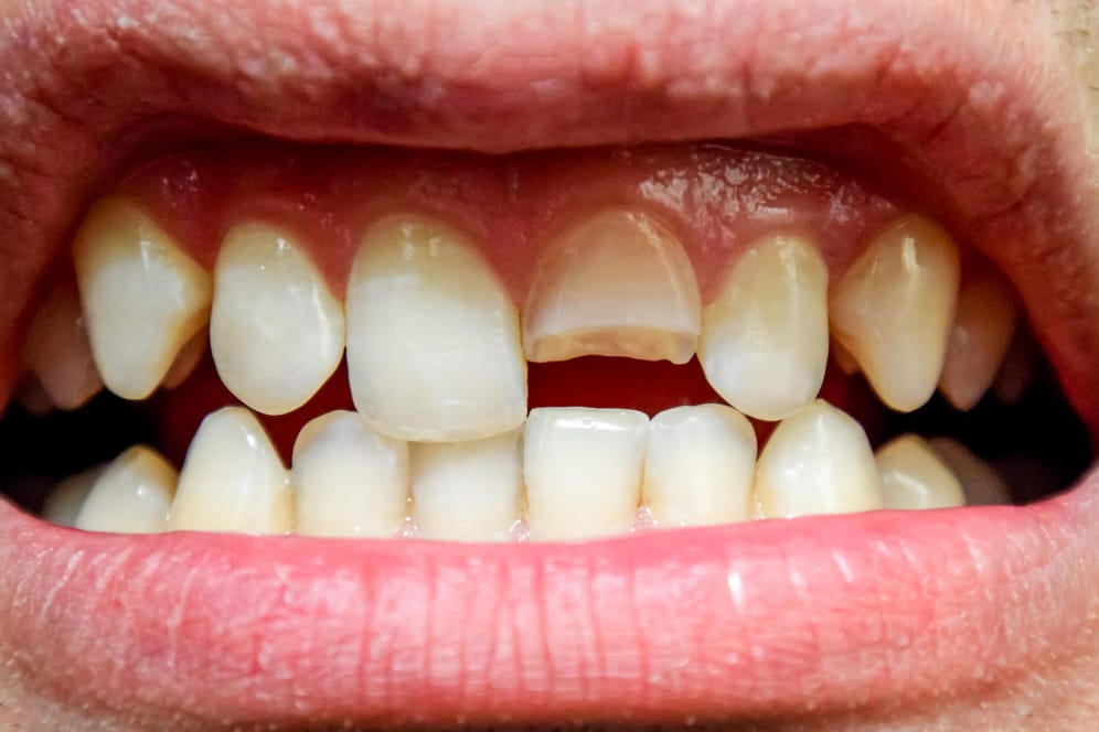Mann mit abgebrochenem Schneidezahn: Wer nachts knirscht, macht seine Zähne kaputt.