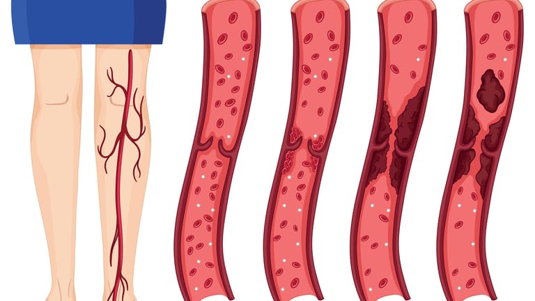 Grafische Darstellung eines Beins und einer Vene: Das Blut verklumpt zu Gerinnseln, eines löst sich und wandert durch den Körper.