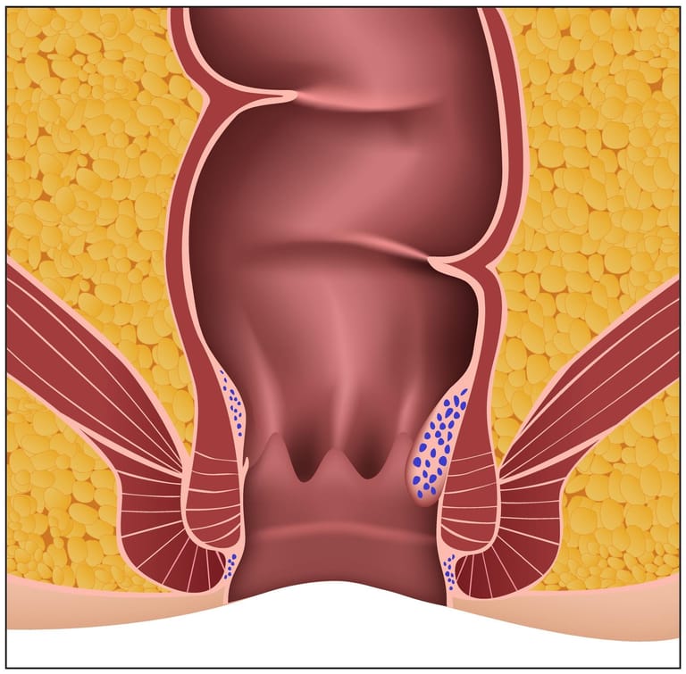 Schweregrad 2: Beim Pressen wölben sich die Hämorrhoidalknoten (in der Grafik blau) nach außen, danach ziehen sie sich aber wieder zurück. Die Vergrößerung ist erkennbar und hinterlässt ein unangenehmes Fremdkörpergefühl.