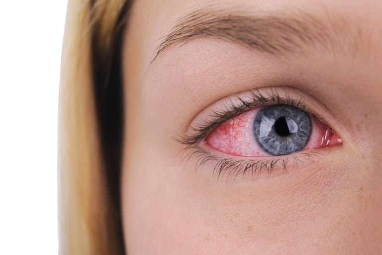 Nicht selten breitet sich die Krankheit auch aufs Auge aus. Daher ist bei Bechterew-Patienten die Regenbogenhaut (Iris) oft entzündet.