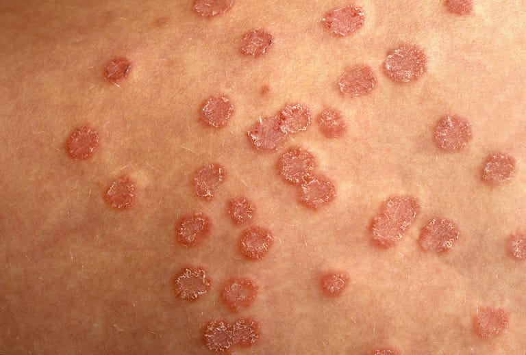 Tinea corporis: Pilzinfektion am Oberschenkel. Diese Hautpilz wird auch Ringelflechte genannt.