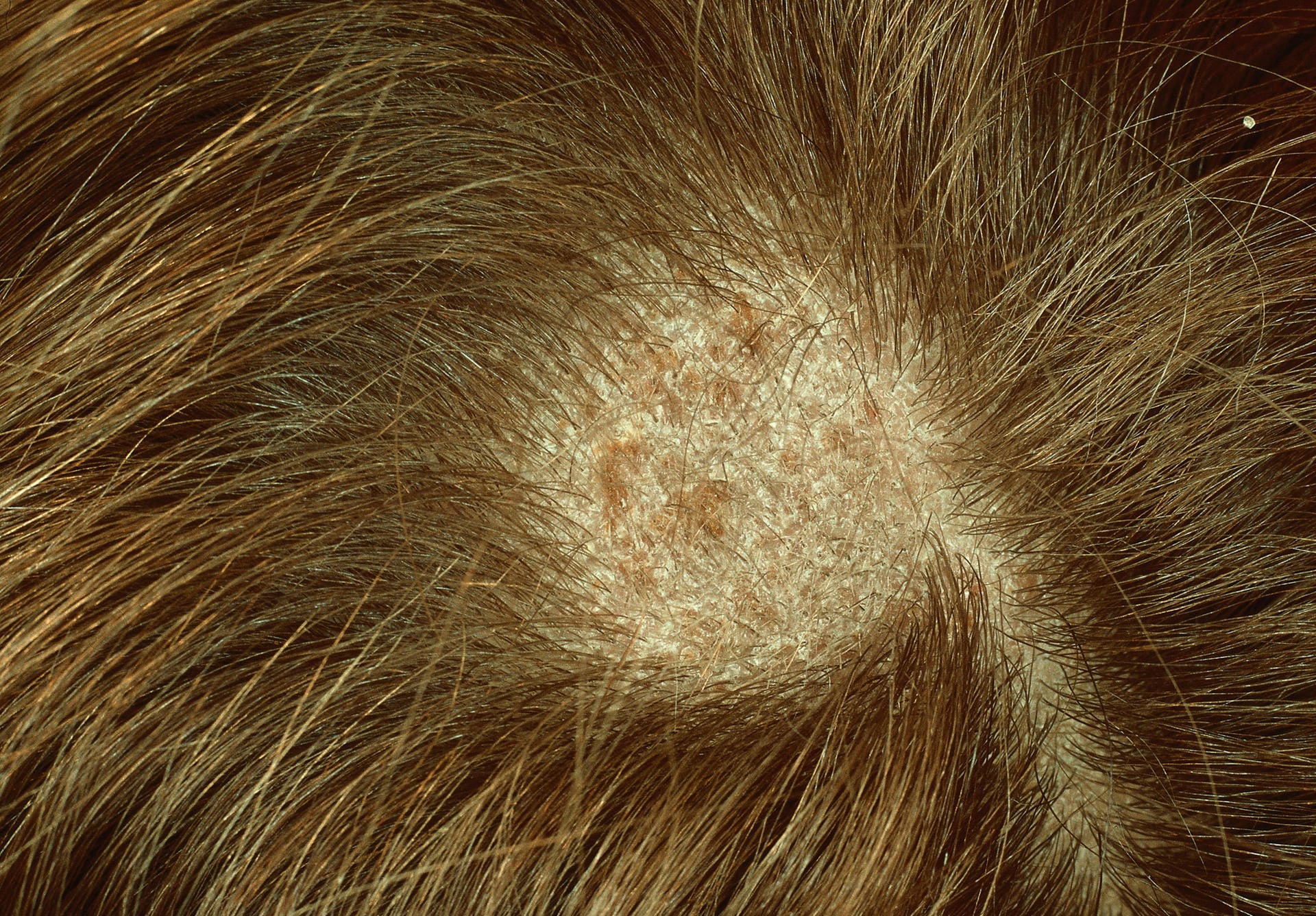 Tinea capitis: Pilzbefall der Kopfhaut mit kreisrundem Haarausfall, auch genannt "Scherpilzflechte".