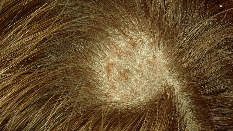 Tinea capitis: Pilzbefall der Kopfhaut mit kreisrundem Haarausfall, auch genannt "Scherpilzflechte".