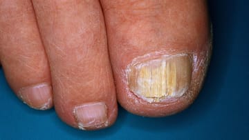 Nagelpilz: Onychomykose am Fußnagel des großen Zehs.