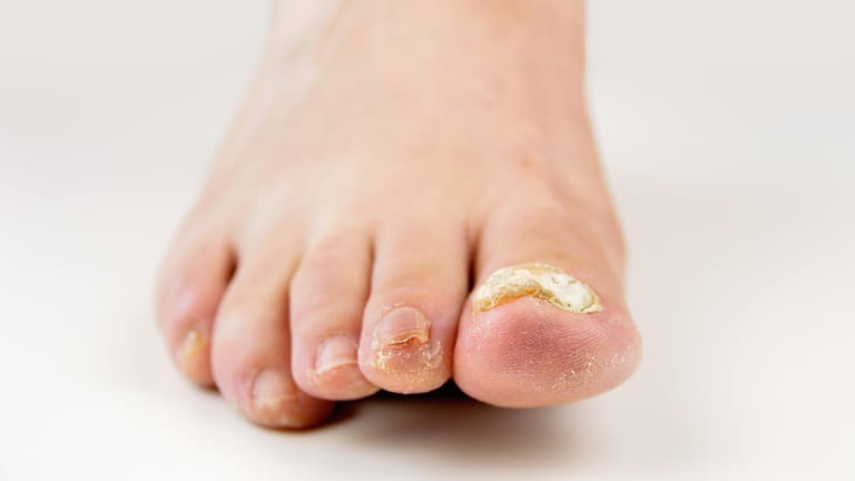 Wie Fußpilz entsteht auch Nagelpilz langsam, oft über viele Jahre hinweg.