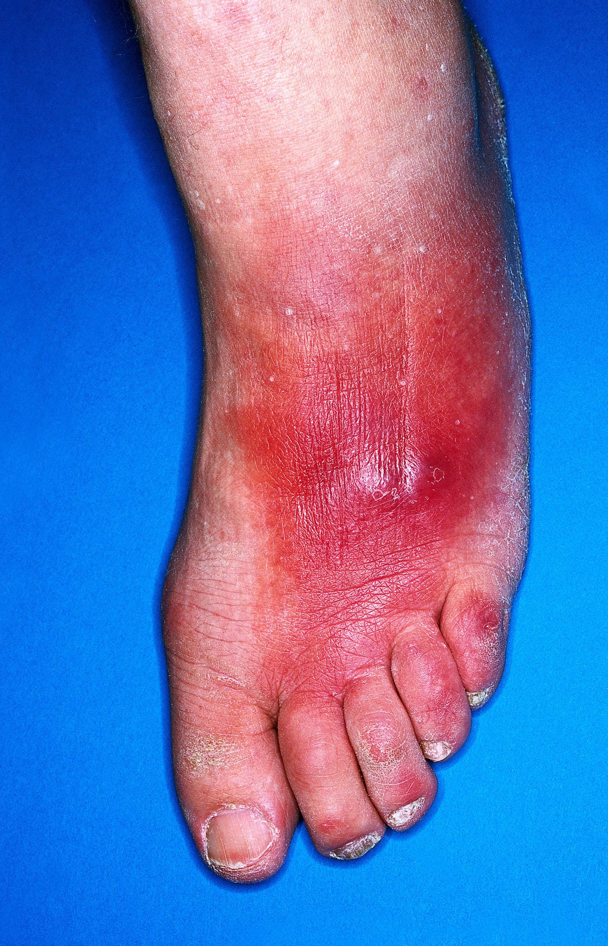 Eine Wundrose nach einer Verletzung auf dem Fußrücken.