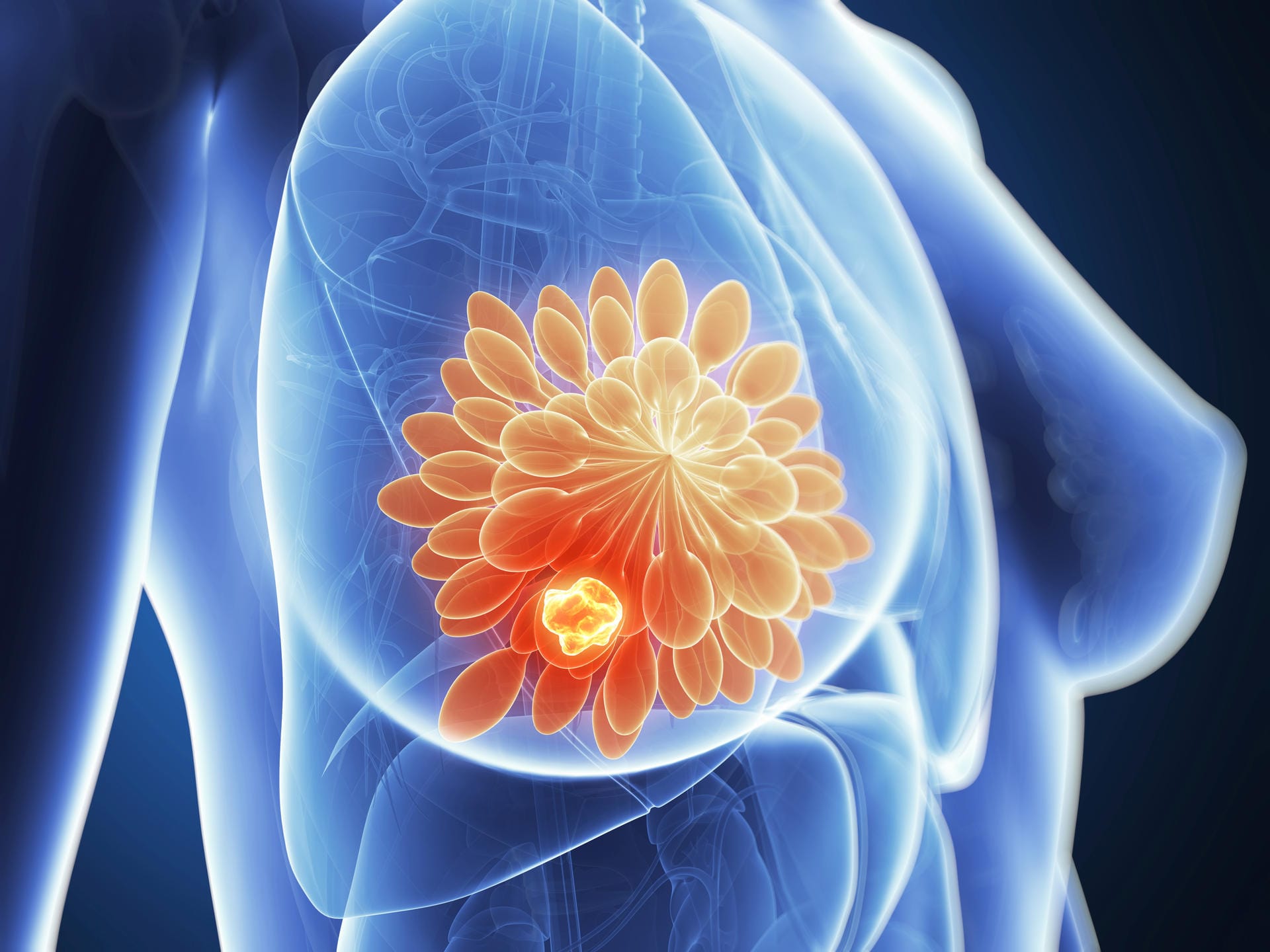 Abbildung einer weiblichen Brust: Um das Risiko für Brustkrebs zu senken, werden harmlose Zysten und Wucherungen oft entfernt.