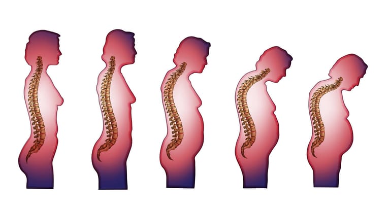 3. "Osteoporosebäuchlein": In Folge der starken Rückenverkrümmung wölbt sich oft auch der Bauch nach vorne, so dass eine S-förmige Linie entsteht. Im Volksmund spricht man dann vom „Osteoporosebäuchlein“.